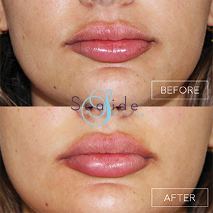 Lip Filler Before & After