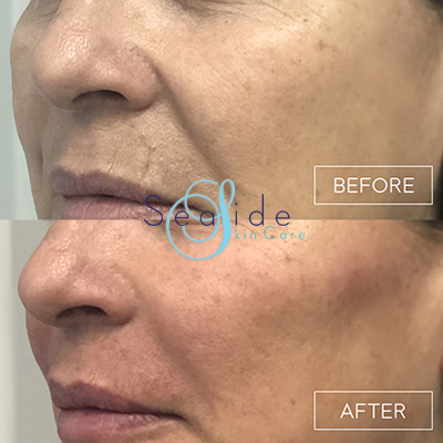 Cheek Filler Before & After