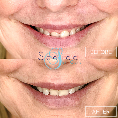 Botox Lip Flip Before & After