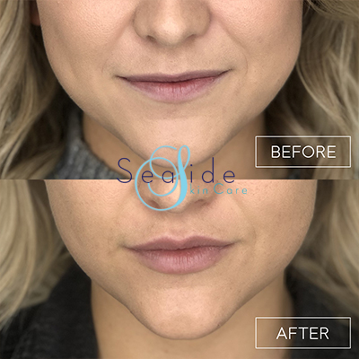 Lip Filler Before & After