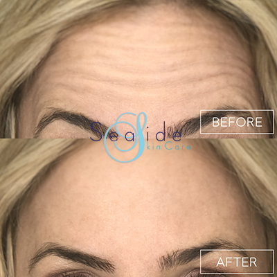 Botox Forehead Before & After