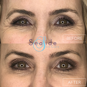 Botox Before & After