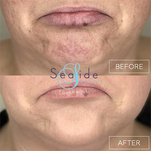 Botox Before & After Chin