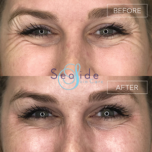 Botox Before & After Crows Feet