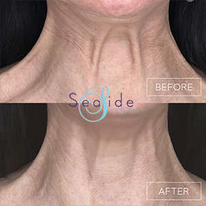 Botox Before & After Platysmal Bands