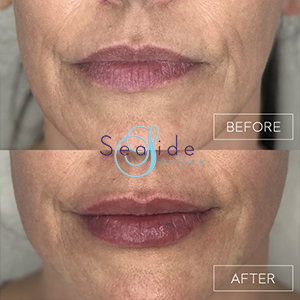 Lip Filler Before & After