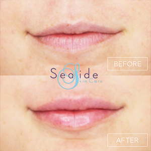 Lip Filler Before & After