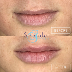 Lip Filler Before & After