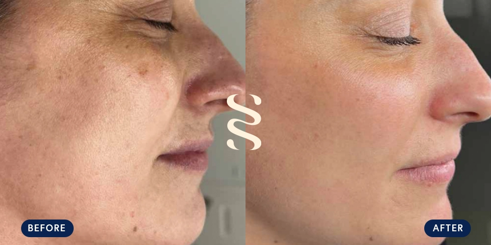 Before & After Super Moxi