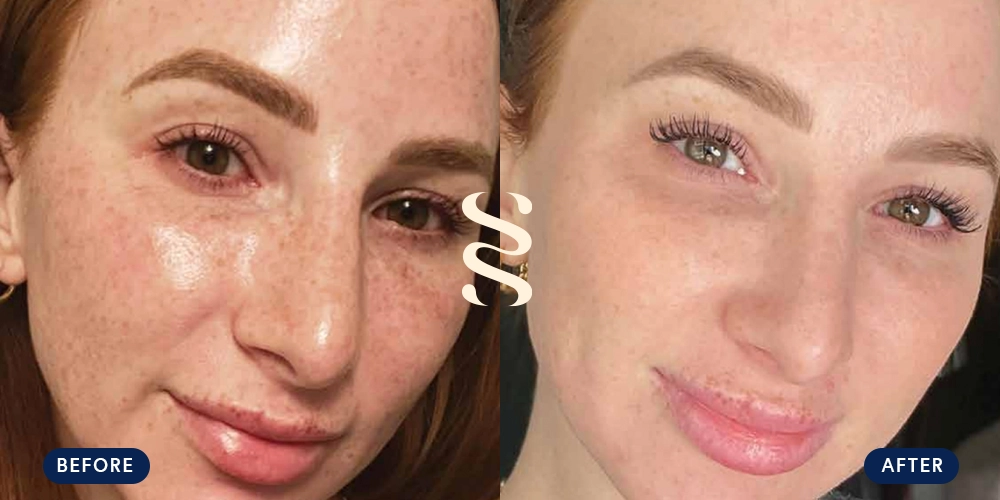 Before & After Super Moxi