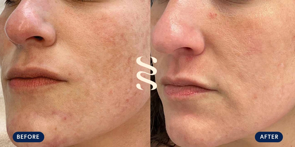 Before & After Super Moxi