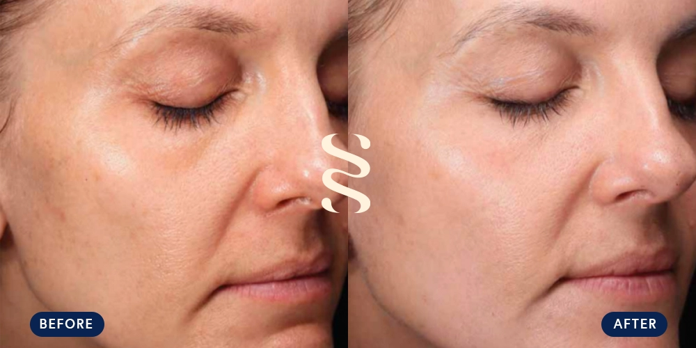 Before & After Tribrid Patient