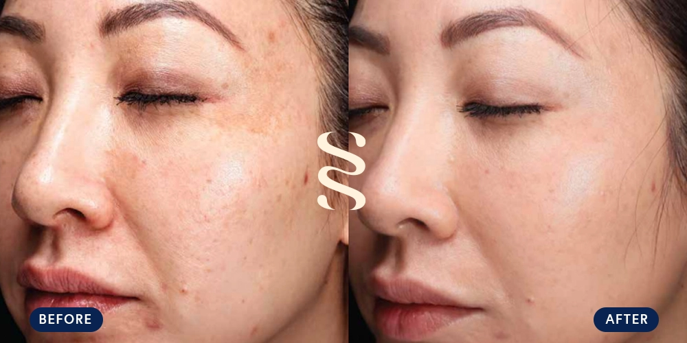 Before & After Tribrid Patient