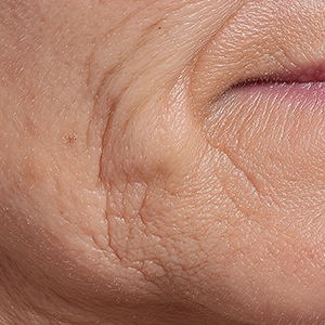 Fine Lines & Wrinkles