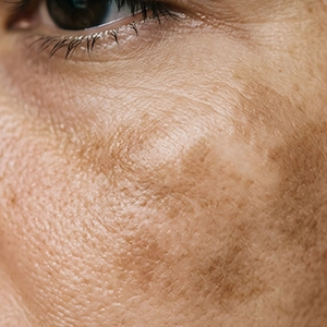 Pigmentation