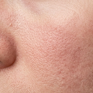 Uneven skin tone